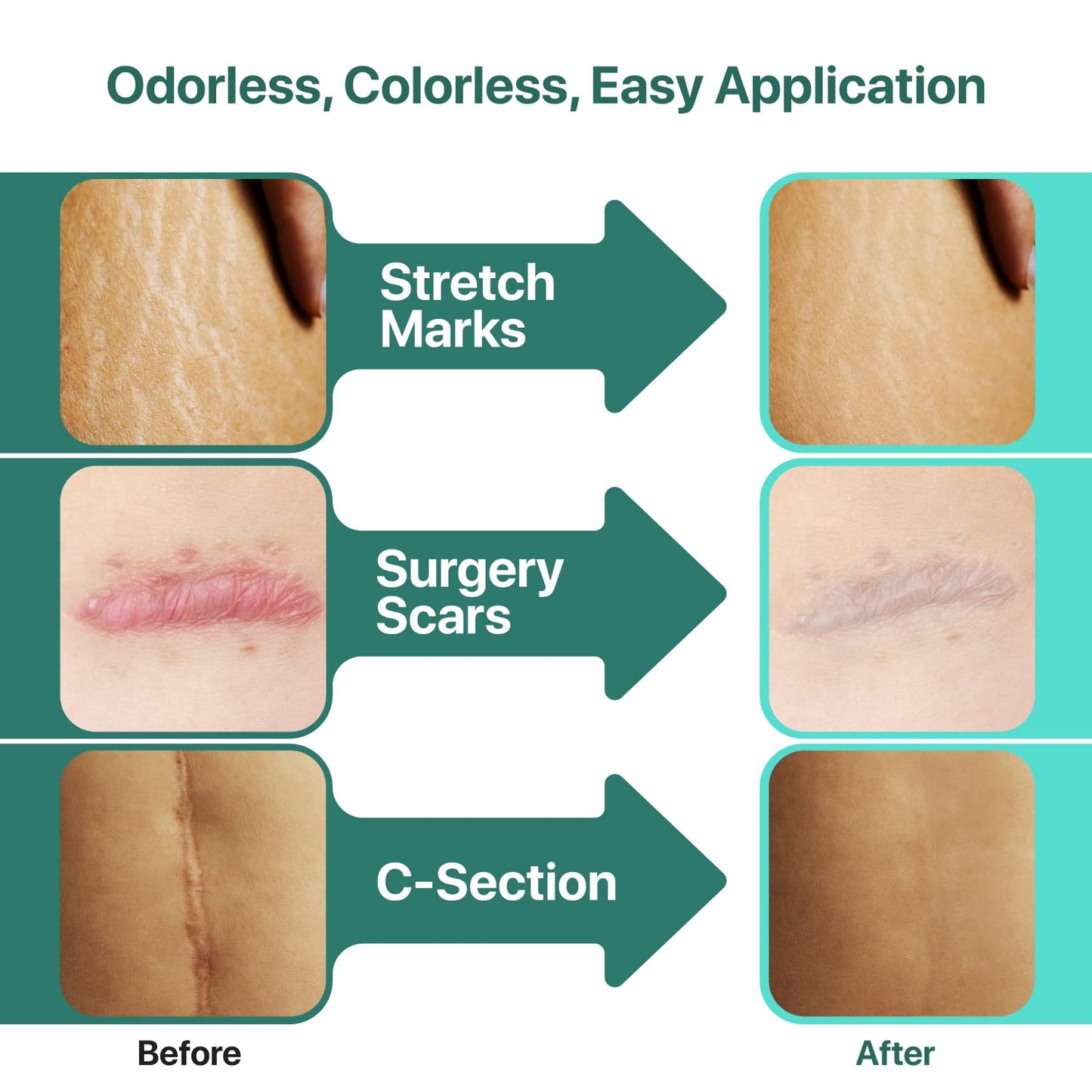 Ebanel Bundle of 30% AHA 2% BHA Chemical Peel and Advanced Silicone Scar Gel