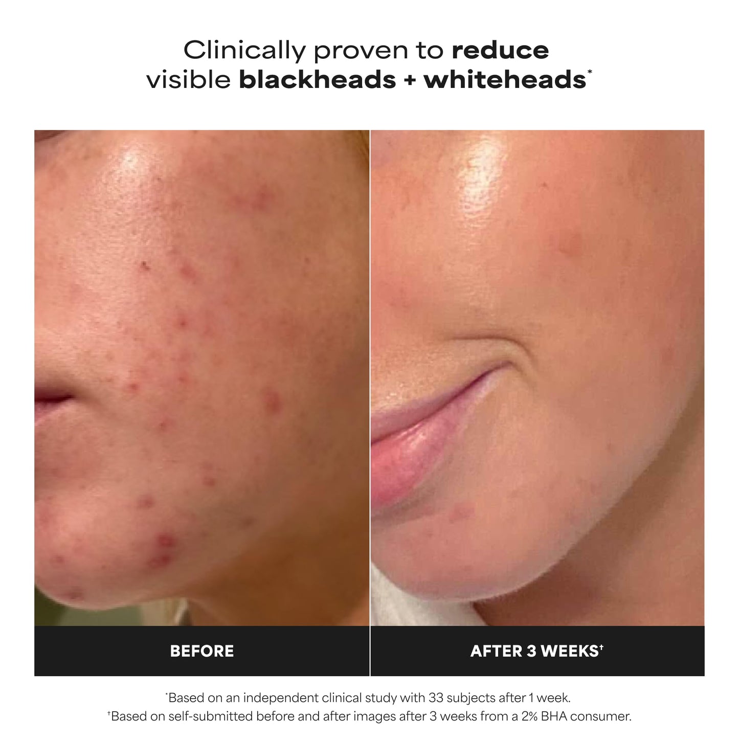 Paulas Choice--SKIN PERFECTING 2% BHA Liquid Salicylic Acid Exfoliant--Facial Exfoliant