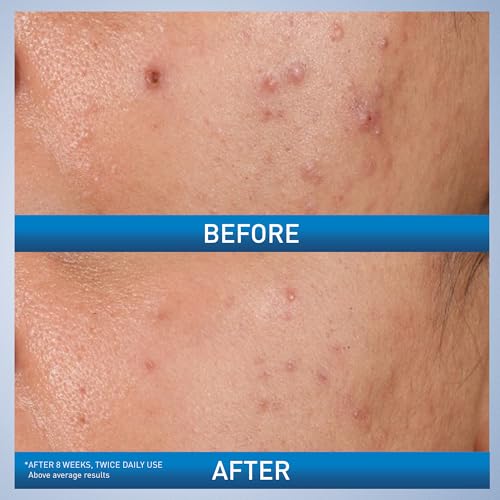 CeraVe Acne Control Gel, 2% Salicylic Acid Treatment With Glycolic Acid + Lactic Acids