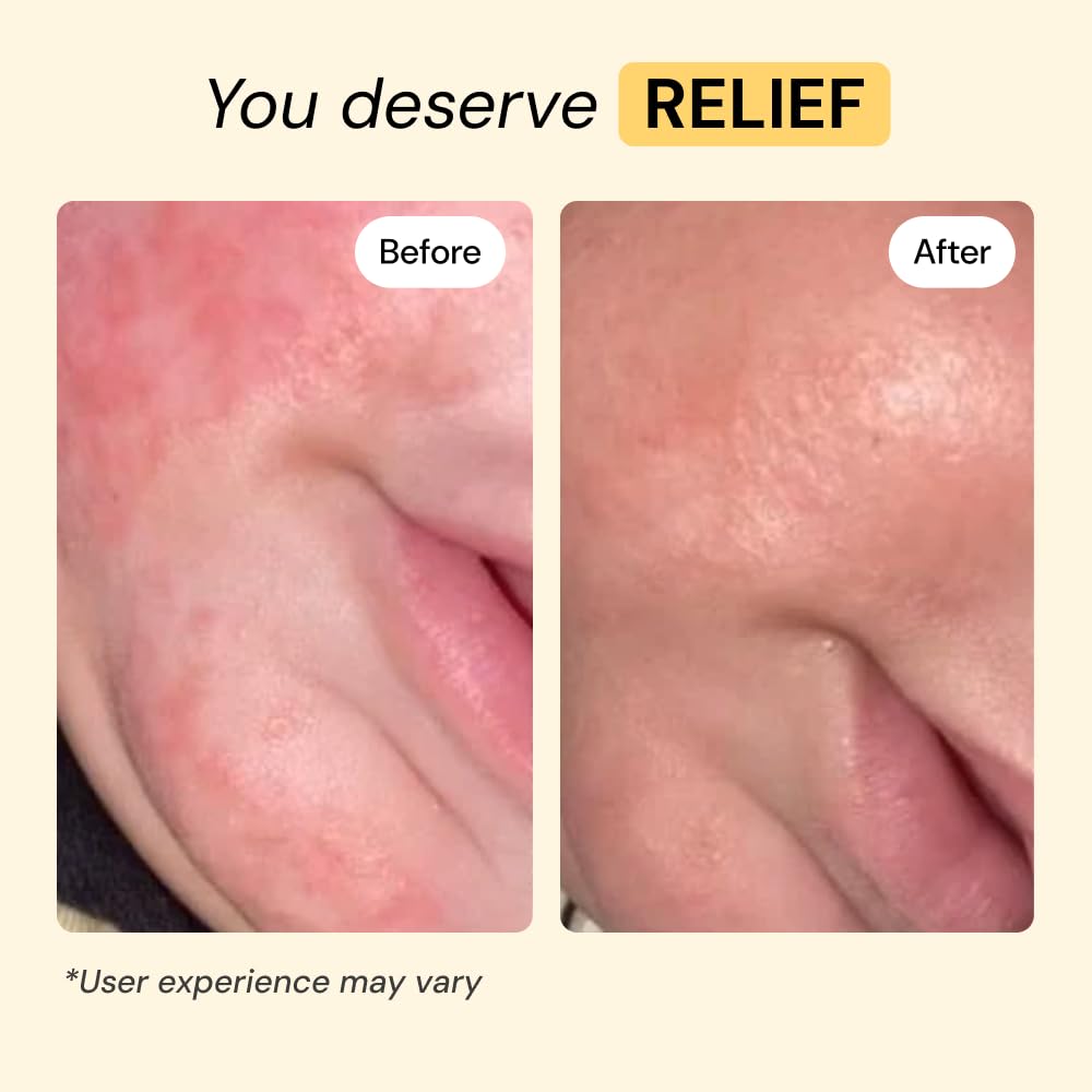 MyMagicHealer Universal Flare Care | Essential Oil Free | Baby Dermatitis, Diaper Rash, Eczema, Psoriasis, Impetigo | Wound Car