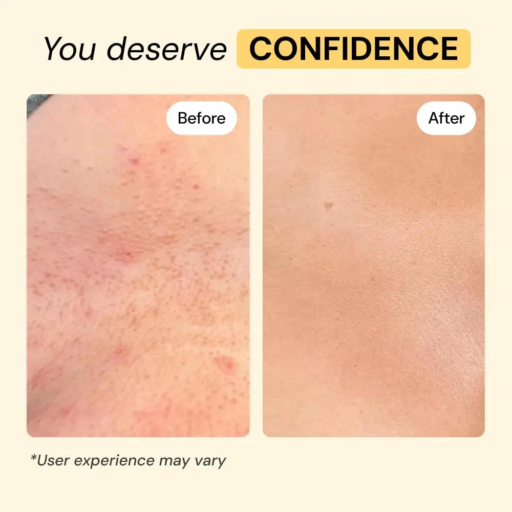 MyMagicHealer Universal Flare Care – Multi-Purpose Solution | Skin Flare-Ups - Hidradenitis Suppurativa, Folliculitis, Boils, Cysts | Anti-Chafing | Irritated Skin Relief w/Propolis & Egg Yolk 1 oz MyMagicHealerBuy Supplements Australia