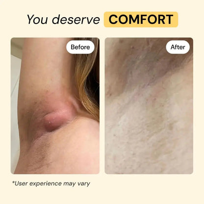 MyMagicHealer Universal Flare Care – Multi-Purpose Solution | Skin Flare-Ups - Hidradenitis Suppurativa, Folliculitis, Boils, Cysts | Anti-Chafing | Irritated Skin Relief w/Propolis & Egg Yolk 1 oz MyMagicHealerBuy Supplements Australia