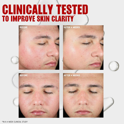 Thayers Blemish Clearing Salicylic Acid Toner, Acne Treatment Face Toner with 2% Salicylic Acid
