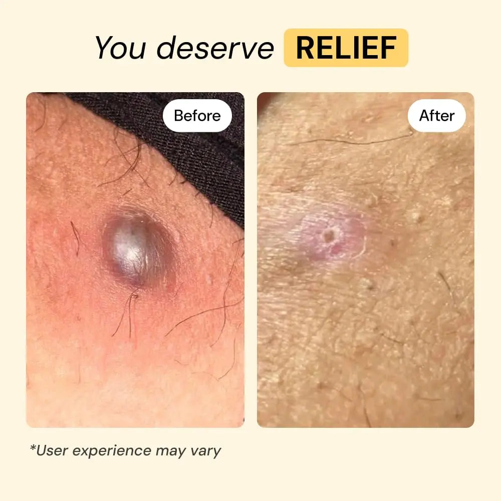 MyMagicHealer Universal Flare Care – Multi-Purpose Solution | Skin Flare-Ups - Hidradenitis Suppurativa, Folliculitis, Boils, Cysts | Anti-Chafing | Irritated Skin Relief w/Propolis & Egg Yolk 1 oz MyMagicHealerBuy Supplements Australia