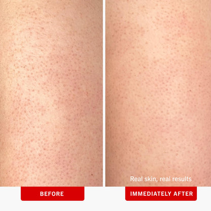 First Aid Beauty - KP Bump Eraser Body Scrub with 10% AHA, Keratosis Pilaris Exfoliator with Glycolic and Lactic acids, Helps Reduce Chicken Skin Bumps