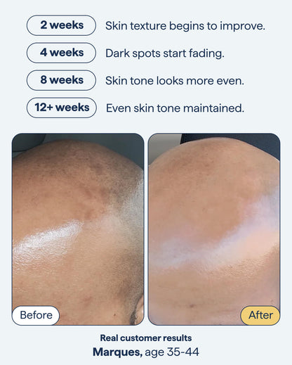 Remedy for Dark Spots | Advanced Night Treatment with Retinol & Kojic Acid | For Discoloration and Uneven Tones | With Glutathione