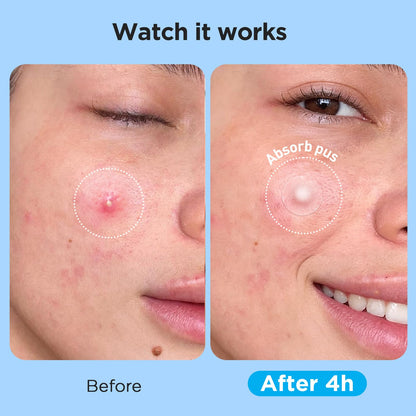 Glowpatch Pimple Patches for Face (504 Count), FSA Eligible Acne Patch Bulk, Zit Stickers 4 Sizes, Hydrocolloid Spot Stickers