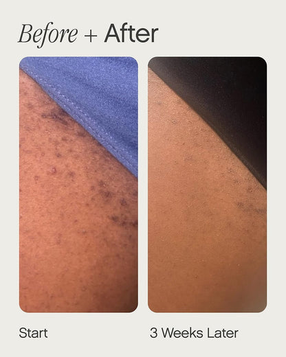 Topicals High Roller Ingrown Hair Serum | Roll-on Tonic to Soothe and Calm Irritated Skin