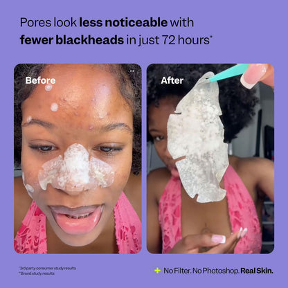 Peach Slices - Nose Pore Patches (7 ct) - Overnight Blackhead Remover - Pore Strips - Absorbs Gunk - Thin, Flexible & Painless - Hydrocolloid Patches