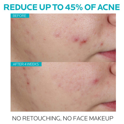 La Roche-Posay Effaclar Salicylic Acid Treatment to Minimize Pores, Clear Acne Blemishes and Post Acne Marks