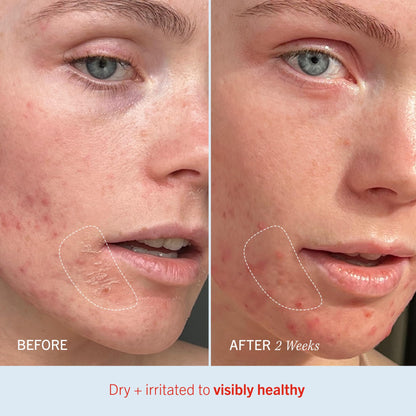 First Aid Beauty - Ultra Repair Cream, Intense Hydration Whipped Colloidal Oatmeal, Clinically Proven to Strengthen Skin Barrier in 7 Days