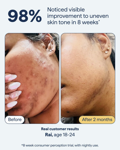 Remedy for Dark Spots | Advanced Night Treatment with Retinol & Kojic Acid | For Discoloration and Uneven Tones | With Glutathione