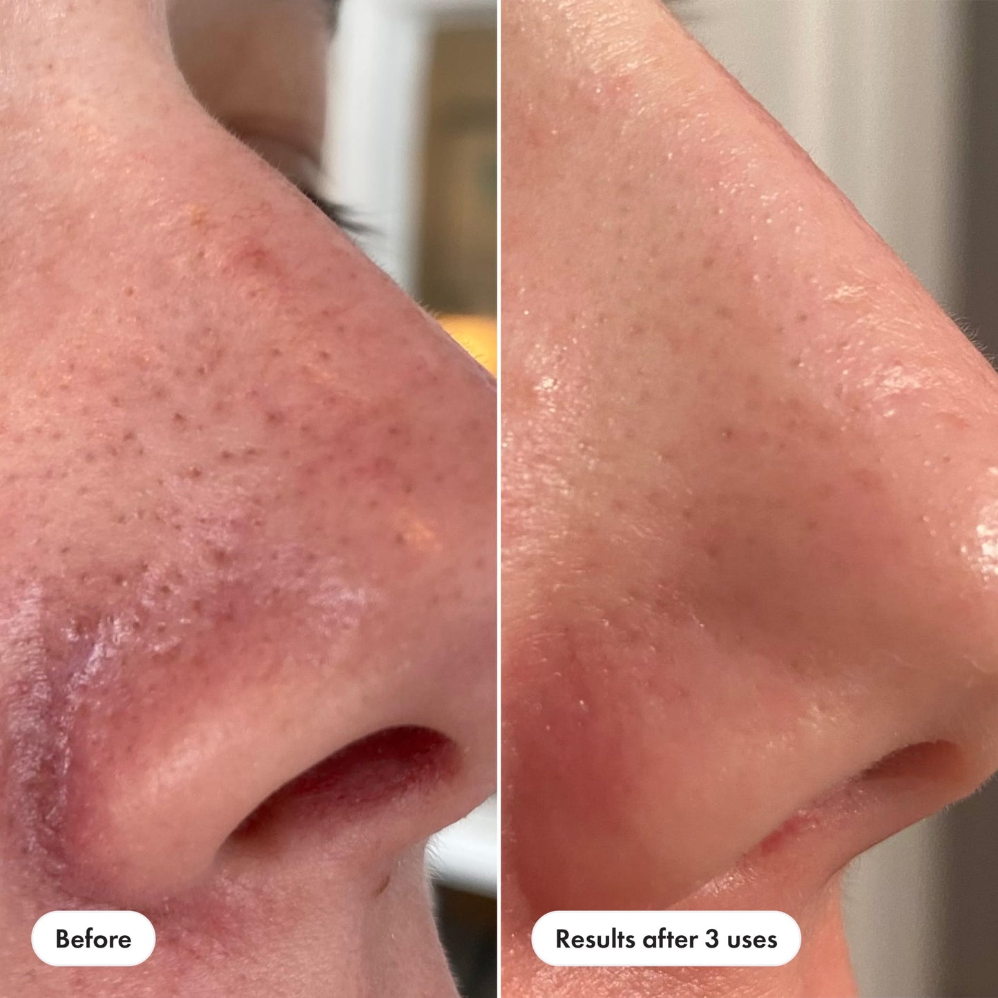 Hero Cosmetics Pore Release Blackhead Clearing Solution, Exfoliating 2% Salicylic Acid Toner Featuring AHA, BHA, and PHA