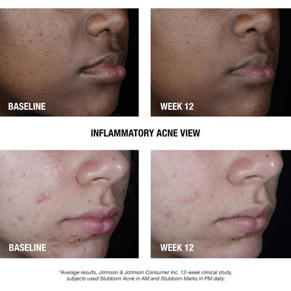 Neutrogena Stubborn Acne AM Face Treatment with 2.5% Micronized Benzoyl Peroxide Acne Medication, Oil-Free Daily Facial Treatment Reduces Size